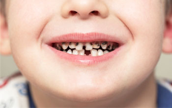Причины раннего разрушения зубов у детей